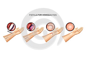 Fistula for hemodialysis. suturing of vein and artery