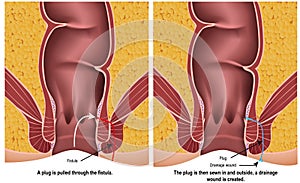 Fistula plug medical  illustration on white background with description photo