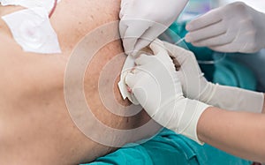 Fix epidural catheter