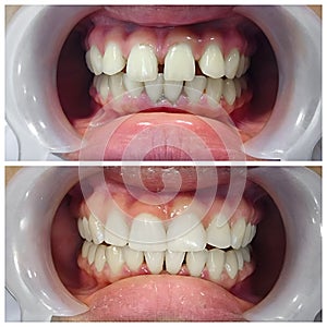 Before and after fixation for huge gap between front teeth or incisors, diastema