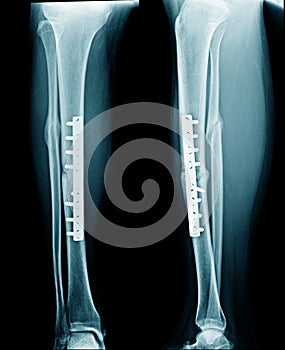 Fixation shaft of tibia x-ray image