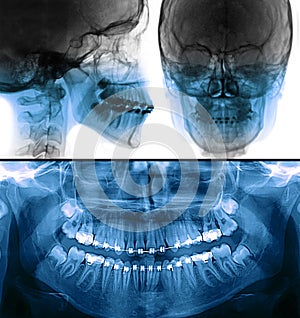 Fixed appliance brackets x-ray, orthodontic treatment photo