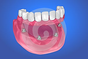 Fixed bridge on implants. Medically accurate