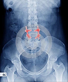 Fixed compression fracture