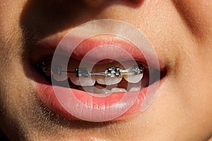 Fixed device with elastic on the teeth of a teenager