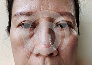 The flabbiness adipose sagging skin on the face