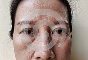 The flabbiness adipose sagging skin on the face