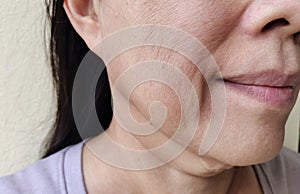 The Flabbiness adipose sagging skin beside the mouth, wrinkles and flabby skin on the face, freckles and acne of the woman.
