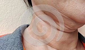 The flabbiness adipose and sagging skin under the neck, wattle and wrinkles, rough skin under the chin of the woman..