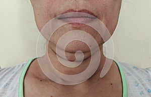 The flabbiness adipose and sagging skin under the neck, wrinkles and rough skin under the chin of the woman..