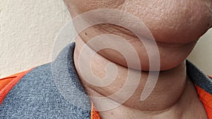 The flabbiness adipose and sagging skin under the neck, wrinkles and rough skin under the chin of the woman..