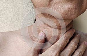 The Flabbiness adipose sagging skin, wattle and cellulite under the chin, wrinkles and flabby under the neck.