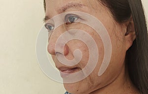 The Flabby and sagging beside the eyelid, wrinkled and blemishes on the face, dullness skin of the woman