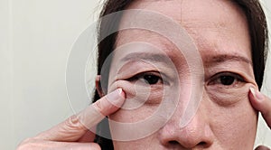 The Flabby skin and cellulite under the eyes, wrinkles and ptosis beside the eyelid, forehead lines on the face