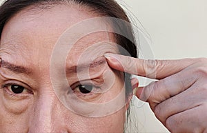 The Flabby skin and cellulite under the eyes, wrinkles and ptosis beside the eyelid, forehead lines on the face