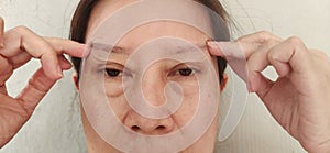 The Flabby skin and cellulite under the eyes, wrinkles and ptosis beside the eyelid, forehead lines on the face