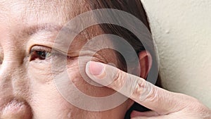 The Flabby skin, wrinkles and ptosis beside the eyelid