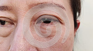 The Flabby skin and wrinkles, ptosis beside the eyelid, freckles and blemish on the face.