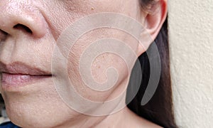 The Flabby and wrinkle beside the mouth, problem blemishes and dark spots on the face. photo