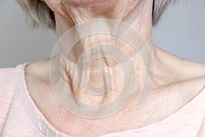 A flabby wrinkled excess skin on the neck of a senior woman close up