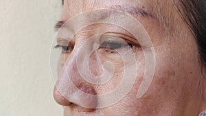 The Flabby wrinkles and ptosis beside the eyelid