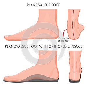 Flat foot with orthopedic insole_Exretnal wiew