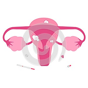 Flat illustration of uterine fibroid photo