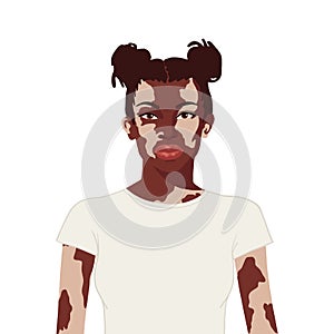 Flat realistic african woman with vitiligo on white background