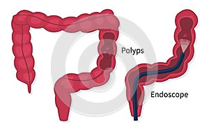 Flat vector of colorectal cancer polyps screening