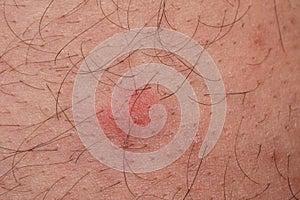 Closeup of flea bite, macro