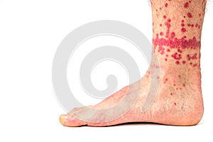 Flea Bites on Human Leg