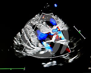 Flow color in echocardiogram