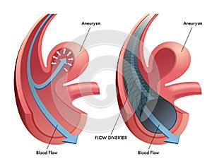 Flow diverter