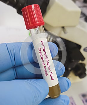 Fluid sample for peritoneal fluid Creatinine levels. Ascites creatinine.