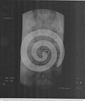 Fluoroscopic Epidural Needle photo