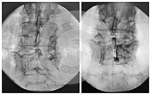 Fluoroscopic guided epidural injection lumbar spine