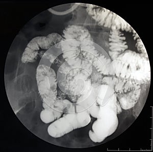 Fluoroscopic X-ray of the small intestine