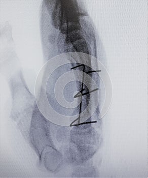 Fluoroscópico imagen fractura dedo un examen 