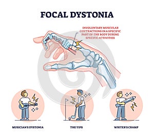 Focal dystonia as anatomical neurological muscle disorder outline diagram