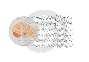 Focal seizure originating from temporal lobe