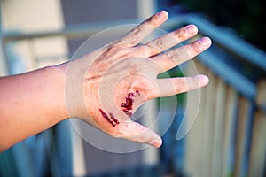 Focus dog bite wound and blood on hand. Infection and Rabies concept.