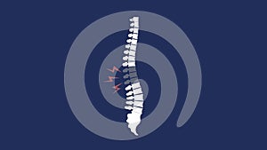 Focused on spine vertebra region. Back ache animated illustration with spine.