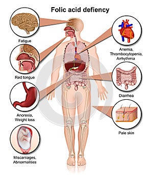 Folic acid defiency 3d medical  illustration infographic