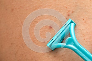 Foliculitis on hairy skin - shaving with razor photo