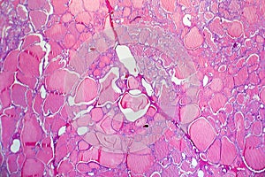 Follicular adenoma of thyroid gland