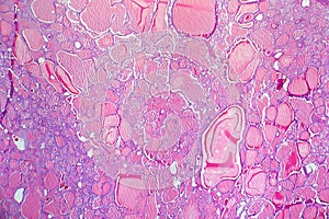 Follicular adenoma of thyroid gland