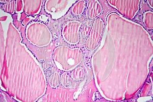 Follicular adenoma of thyroid gland