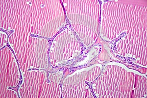 Follicular adenoma of thyroid gland