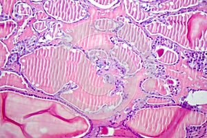 Follicular adenoma of thyroid gland