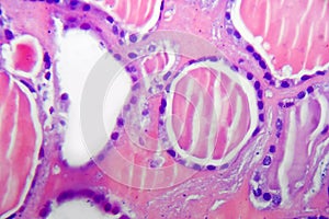 Follicular adenoma of thyroid gland